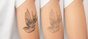 Three photos show a tattoo gradually fading away thanks to laser treatment with a picosecond laser